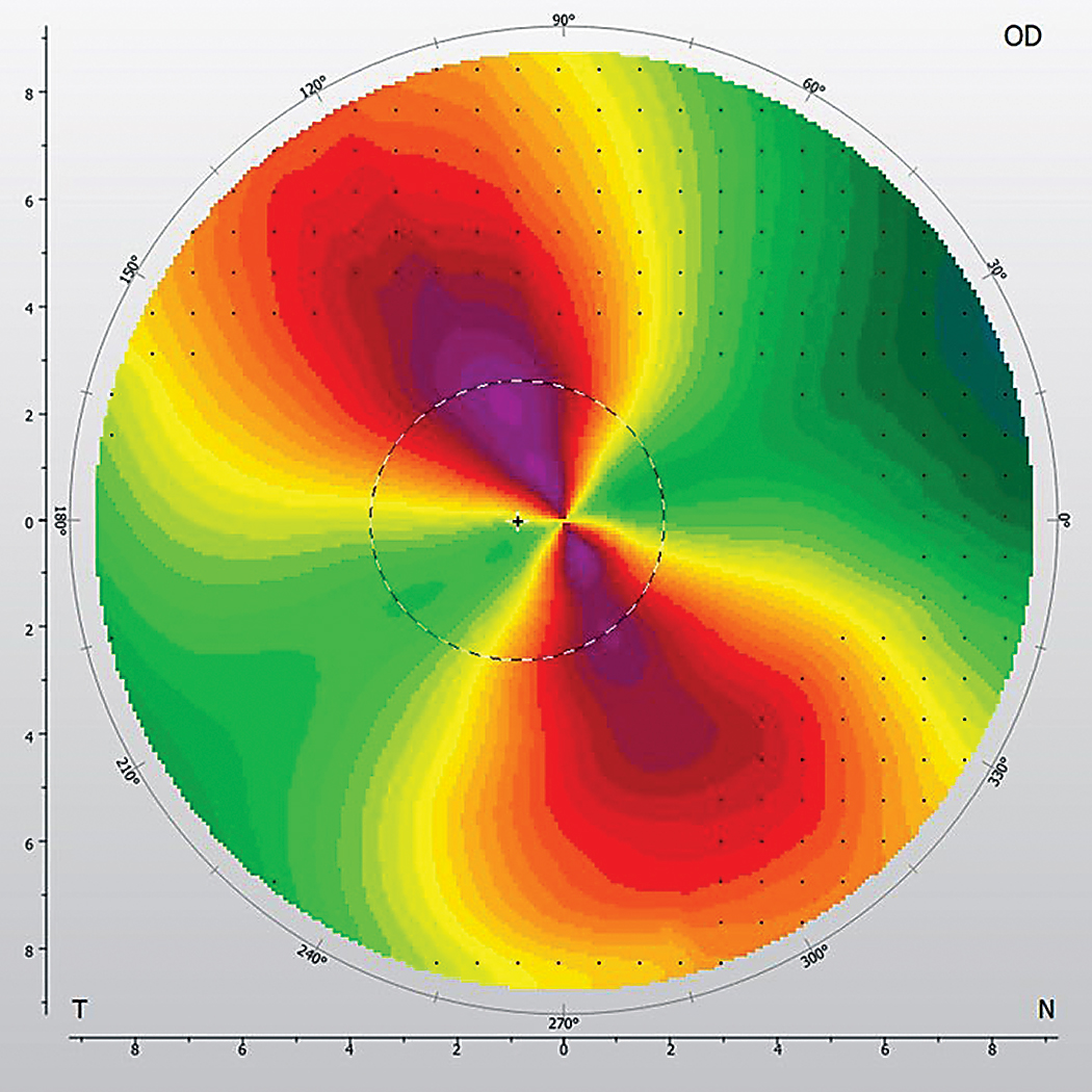 What Does Regular Astigmatism Bilateral Mean